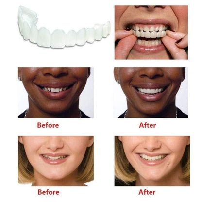 Instant Smile Veneers – Snap-On Perfect Teeth Cover